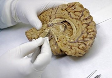 MatemáticaAlzheimer_TipoD